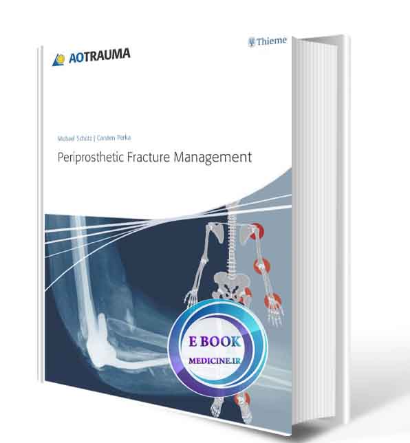 دانلود کتابPeriprosthetic Fracture Management 1st Edition ( PDF)